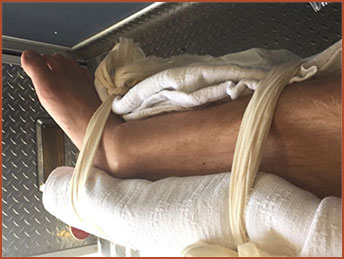 unieruchomienie nogi