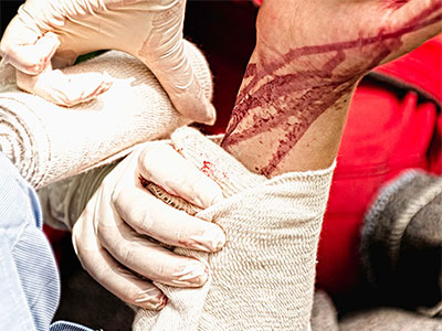 krwotok z przedramienia